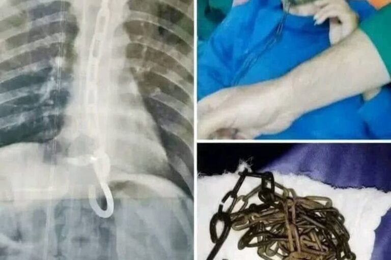 🔵Joven de 23 años Ingiere una Cadena de Metal y Requiere Intervención Quirúrgica de Emergencia
